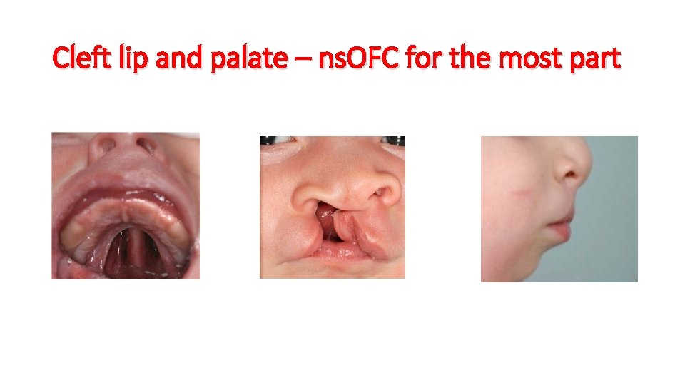 Cleft lip and palate – ns. OFC for the most part 