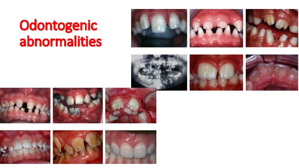 Odontogenic abnormalities 