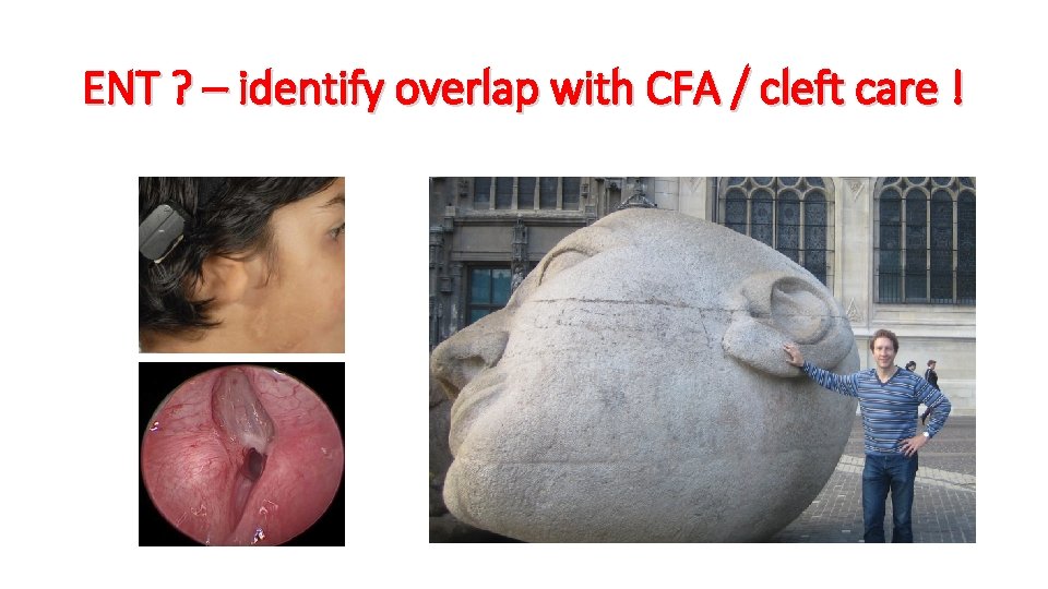 ENT ? – identify overlap with CFA / cleft care ! 
