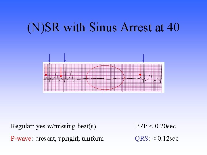 (N)SR with Sinus Arrest at 40 Regular: yes w/missing beat(s) PRI: < 0. 20