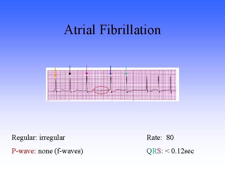 Atrial Fibrillation Regular: irregular Rate: 80 P-wave: none (f-waves) QRS: < 0. 12 sec