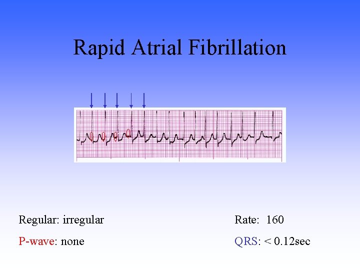 Rapid Atrial Fibrillation Regular: irregular Rate: 160 P-wave: none QRS: < 0. 12 sec