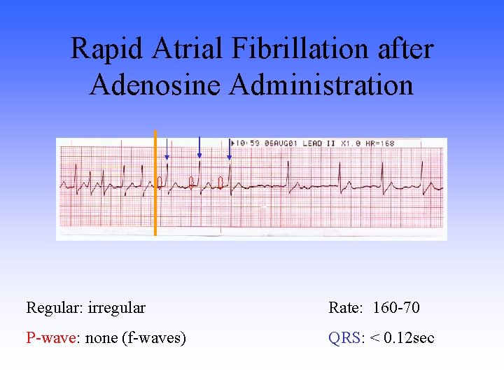 Rapid Atrial Fibrillation after Adenosine Administration Regular: irregular Rate: 160 -70 P-wave: none (f-waves)