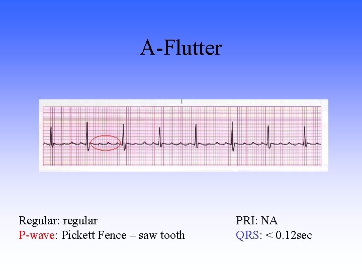 A-Flutter Regular: regular P-wave: Pickett Fence – saw tooth PRI: NA QRS: < 0.