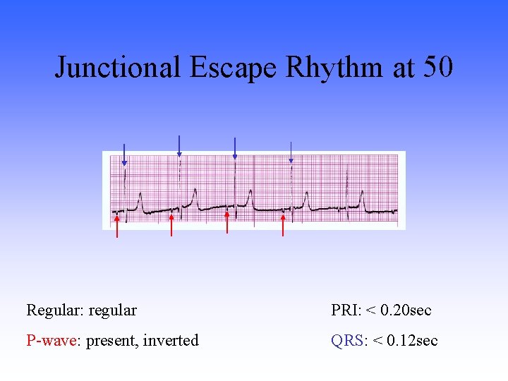 Junctional Escape Rhythm at 50 Regular: regular PRI: < 0. 20 sec P-wave: present,