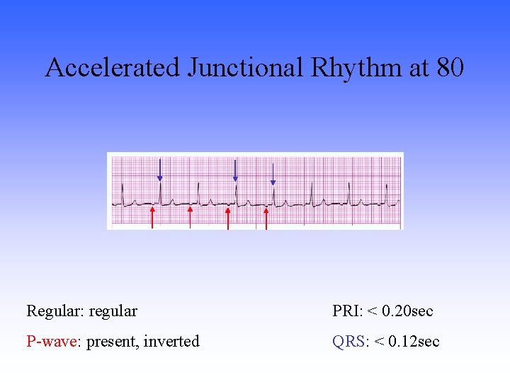 Accelerated Junctional Rhythm at 80 Regular: regular PRI: < 0. 20 sec P-wave: present,