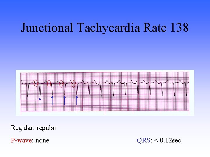 Junctional Tachycardia Rate 138 Regular: regular P-wave: none QRS: < 0. 12 sec 