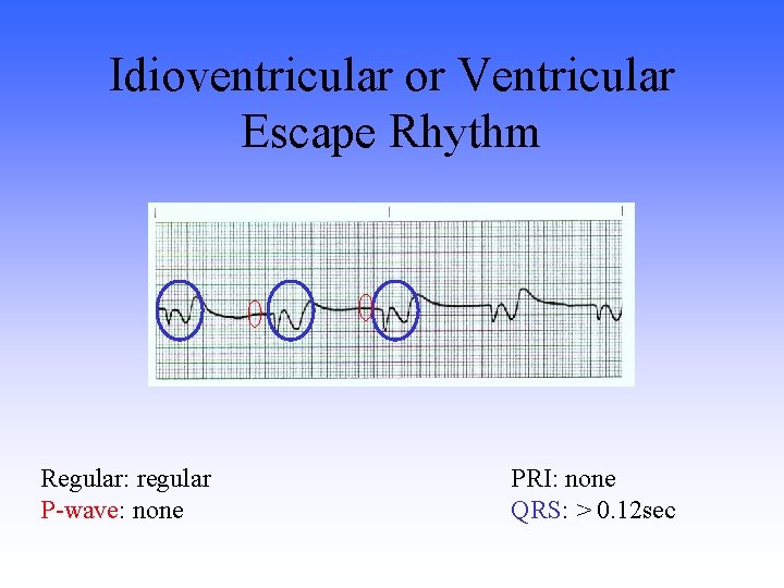 Idioventricular or Ventricular Escape Rhythm Regular: regular P-wave: none PRI: none QRS: > 0.