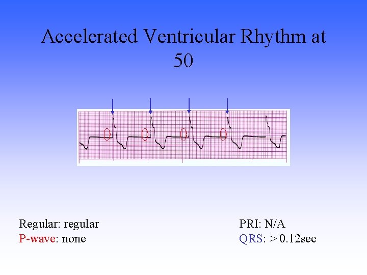 Accelerated Ventricular Rhythm at 50 Regular: regular P-wave: none PRI: N/A QRS: > 0.