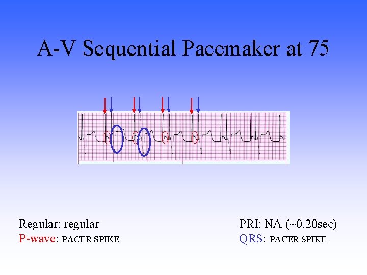 A-V Sequential Pacemaker at 75 Regular: regular P-wave: PACER SPIKE PRI: NA (~0. 20