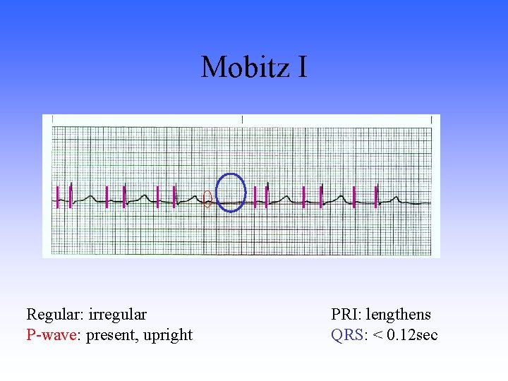 Mobitz I Regular: irregular P-wave: present, upright PRI: lengthens QRS: < 0. 12 sec