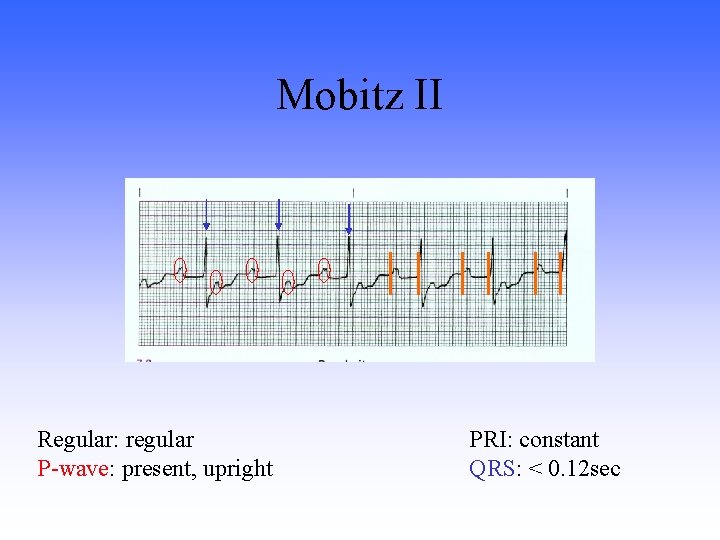 Mobitz II Regular: regular P-wave: present, upright PRI: constant QRS: < 0. 12 sec