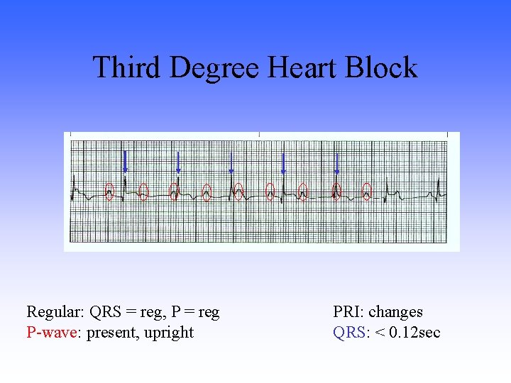 Third Degree Heart Block Regular: QRS = reg, P = reg P-wave: present, upright