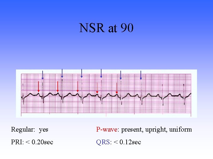 NSR at 90 Regular: yes P-wave: present, upright, uniform PRI: < 0. 20 sec