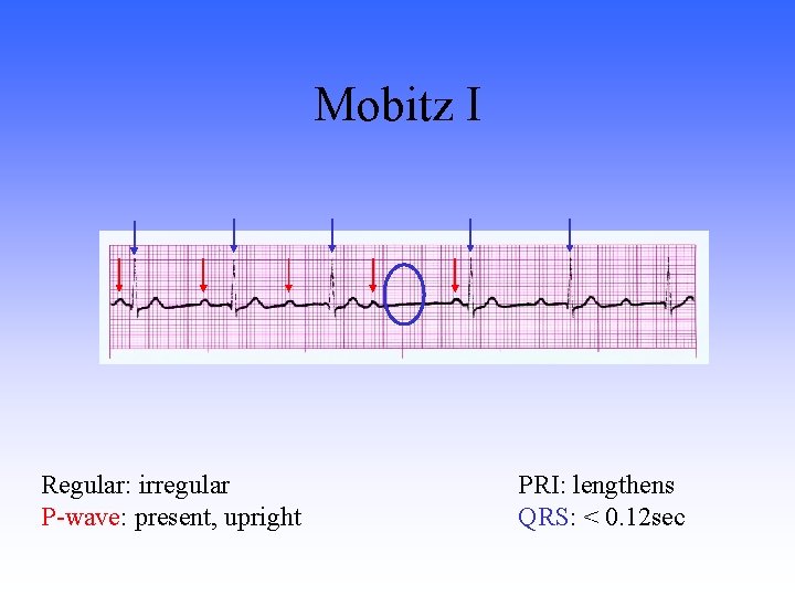 Mobitz I Regular: irregular P-wave: present, upright PRI: lengthens QRS: < 0. 12 sec