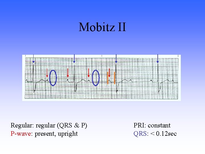 Mobitz II Regular: regular (QRS & P) P-wave: present, upright PRI: constant QRS: <