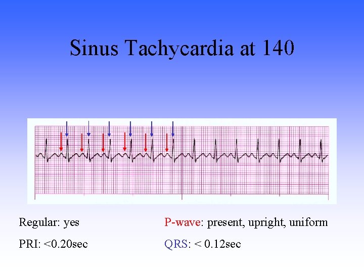 Sinus Tachycardia at 140 Regular: yes P-wave: present, upright, uniform PRI: <0. 20 sec