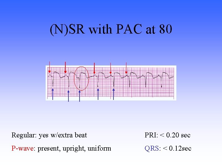 (N)SR with PAC at 80 Regular: yes w/extra beat PRI: < 0. 20 sec