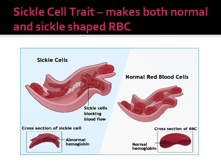 Sickle Cell Trait – makes both normal and sickle shaped RBC 