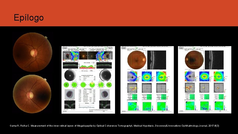 Epílogo Gama R, Relha C. Measurement of the inner retinal layers of Megalopapilla by