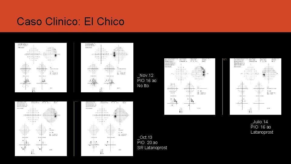 Caso Clinico: El Chico _Nov. 12 PIO 16 ao No tto _Julio. 14 PIO