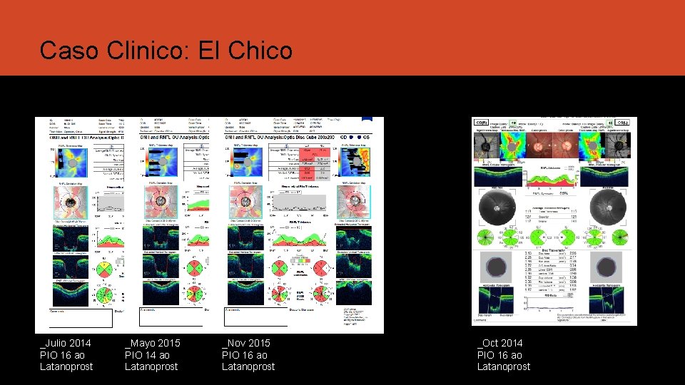 Caso Clinico: El Chico _Julio 2014 PIO 16 ao Latanoprost _Mayo 2015 PIO 14