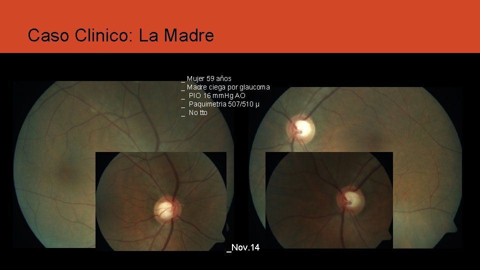 Caso Clinico: La Madre _ Mujer 59 años _ Madre ciega por glaucoma _