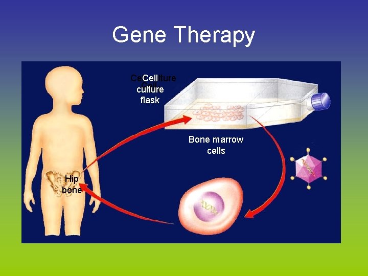 Gene Therapy Cell culture flask Bone marrow cells Hip bone 