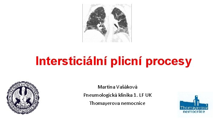 Intersticiální plicní procesy Martina Vašáková Pneumologická klinika 1. LF UK Thomayerova nemocnice 