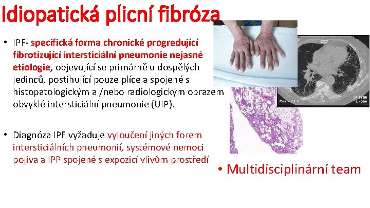 Idiopatická plicní fibróza • IPF- specifická forma chronické progredující fibrotizující intersticiální pneumonie nejasné etiologie,