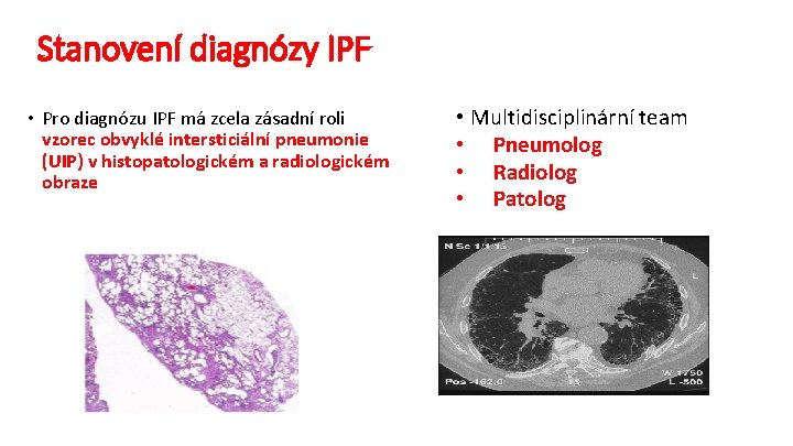 Stanovení diagnózy IPF • Pro diagnózu IPF má zcela zásadní roli vzorec obvyklé intersticiální