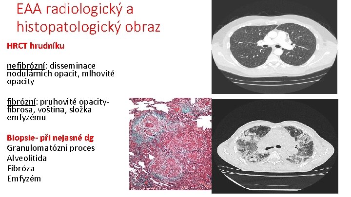 EAA radiologický a histopatologický obraz HRCT hrudníku nefibrózní: disseminace nodulárních opacit, mlhovité opacity fibrózní: