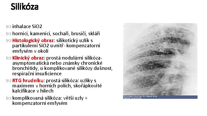 Silikóza inhalace Si. O 2 horníci, kameníci, sochaři, brusiči, skláři Histologický obraz: silikotický uzlík