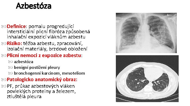 Azbestóza Definice: pomalu progredující intersticiální plicní fibróza způsobená inhalační expozicí vláknům azbestu Riziko: těžba