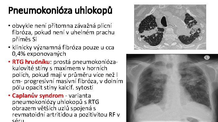 Pneumokonióza uhlokopů • obvykle není přítomna závažná plicní fibróza, pokud není v uhelném prachu