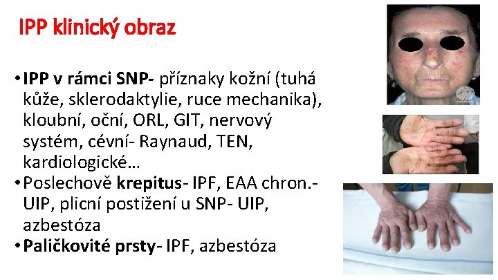 IPP klinický obraz • IPP v rámci SNP- příznaky kožní (tuhá kůže, sklerodaktylie, ruce