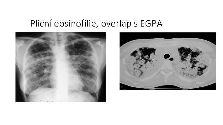 Plicní eosinofilie, overlap s EGPA 