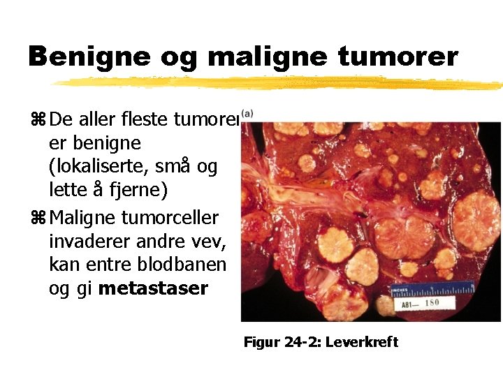 Benigne og maligne tumorer z De aller fleste tumorer er benigne (lokaliserte, små og