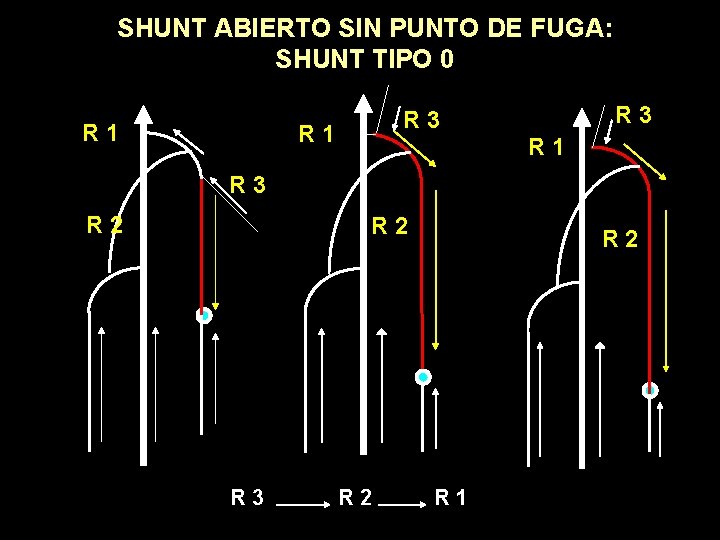SHUNT ABIERTO SIN PUNTO DE FUGA: SHUNT TIPO 0 R 1 R 3 R