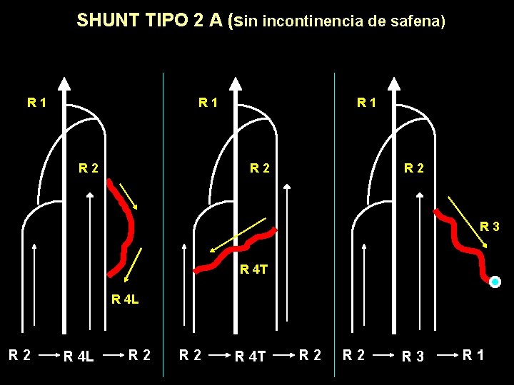 SHUNT TIPO 2 A (sin incontinencia de safena) R 1 R 2 R 3