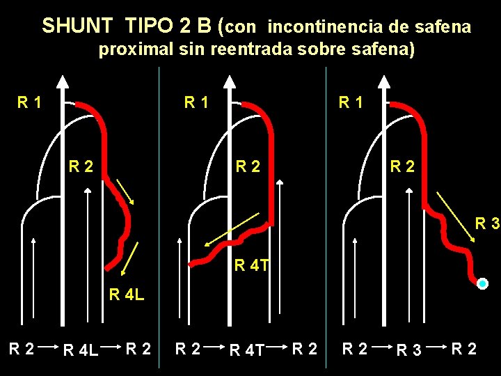 SHUNT TIPO 2 B (con incontinencia de safena proximal sin reentrada sobre safena) R