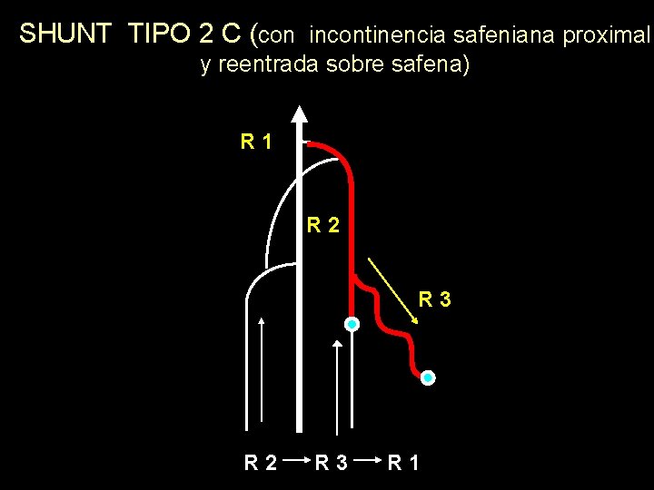 SHUNT TIPO 2 C (con incontinencia safeniana proximal y reentrada sobre safena) R 1