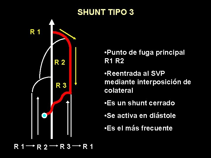 SHUNT TIPO 3 R 1 • Punto de fuga principal R 1 R 2