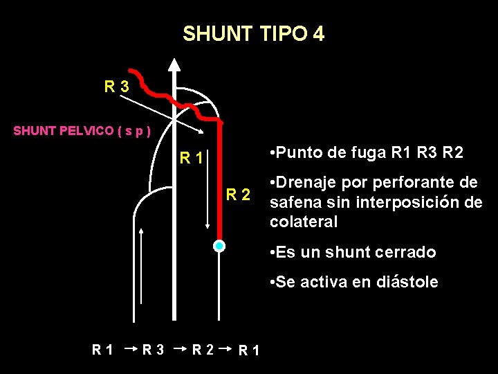 SHUNT TIPO 4 R 3 SHUNT PELVICO ( s p ) • Punto de