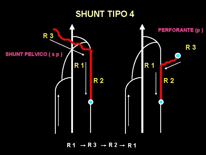 SHUNT TIPO 4 PERFORANTE (p ) R 3 SHUNT PELVICO ( s p )