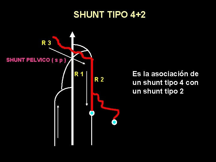 SHUNT TIPO 4+2 R 3 SHUNT PELVICO ( s p ) R 1 R
