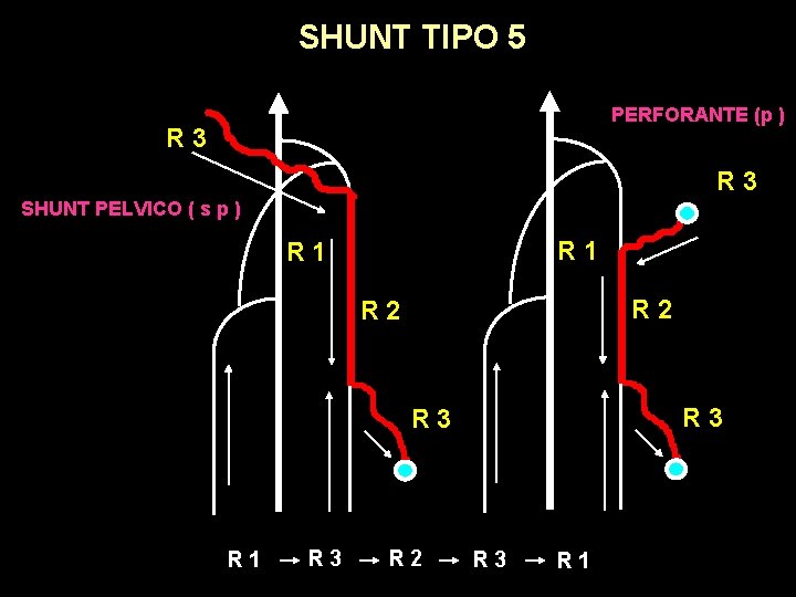 SHUNT TIPO 5 PERFORANTE (p ) R 3 SHUNT PELVICO ( s p )