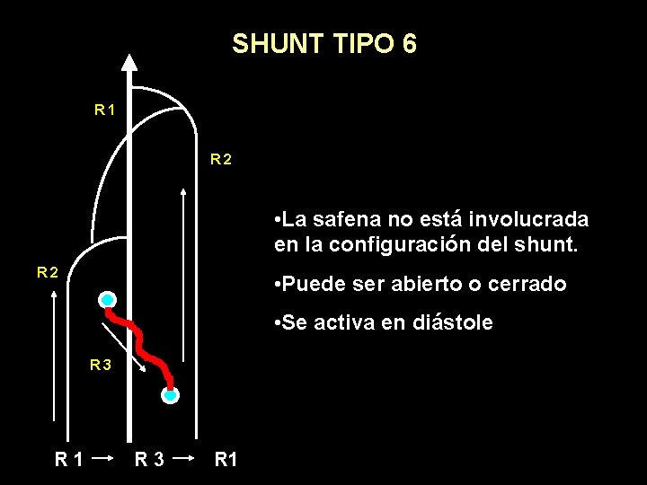 SHUNT TIPO 6 R 1 R 2 • La safena no está involucrada en