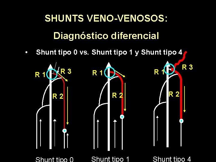 SHUNTS VENO-VENOSOS: Diagnóstico diferencial • Shunt tipo 0 vs. Shunt tipo 1 y Shunt