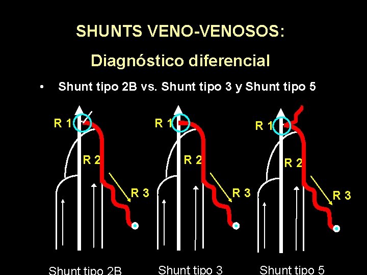 SHUNTS VENO-VENOSOS: Diagnóstico diferencial • Shunt tipo 2 B vs. Shunt tipo 3 y